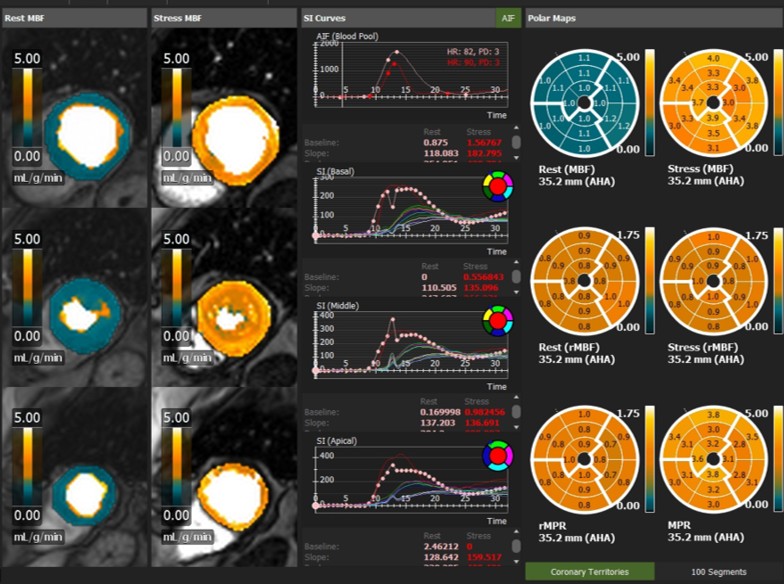 Quantitative perfusion